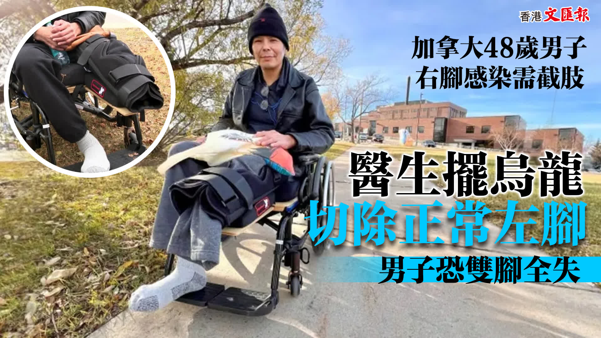 减拿小大48歲良人左腳熏染需截肢　醫去世擺烏龍切除了同样艰深左腳