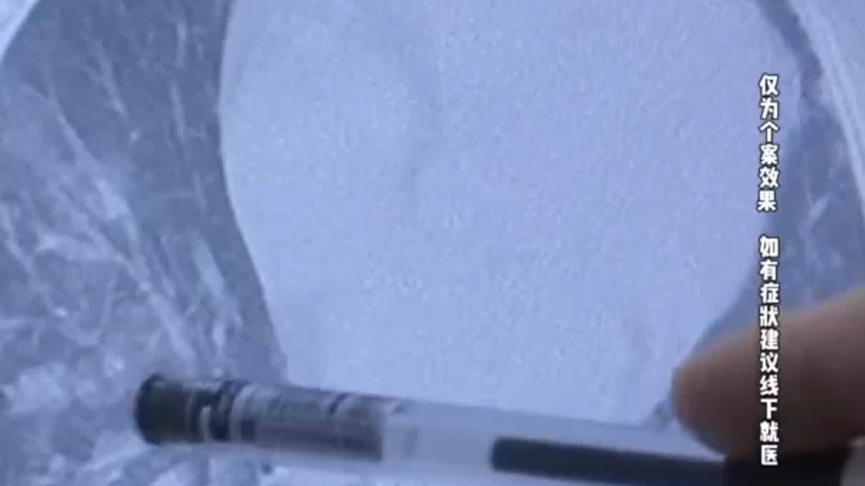 羽絨服「漏絨」致呼吸衰竭！醫生：警惕「羽絨肺」