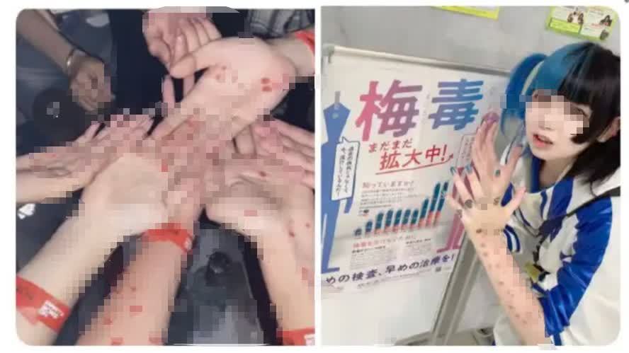 日本年輕人聚眾曬梅毒、化「梅毒妝」　這是什麼毒操作？